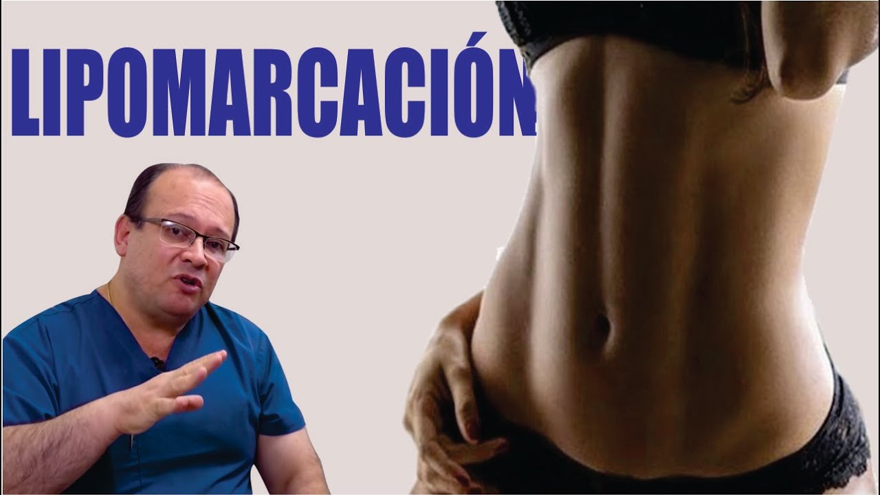 Lipo HD o Marcaci&oacute;n Abdominal 👙 LIPOMARCACI&Oacute;N Construye un CUERPO PERFECTO ⭐ Dr ALBERTO CALVO QUIROZ