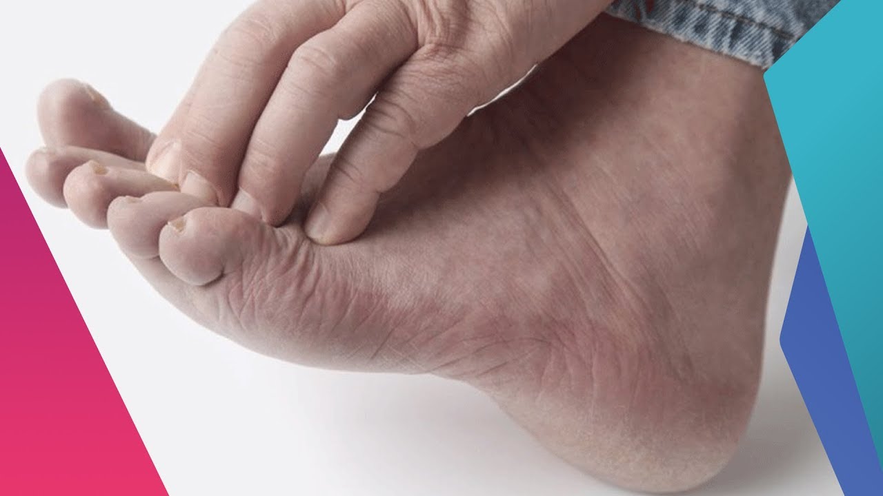 صباح النور│الفطريات الجلدية وكيفية علاجها