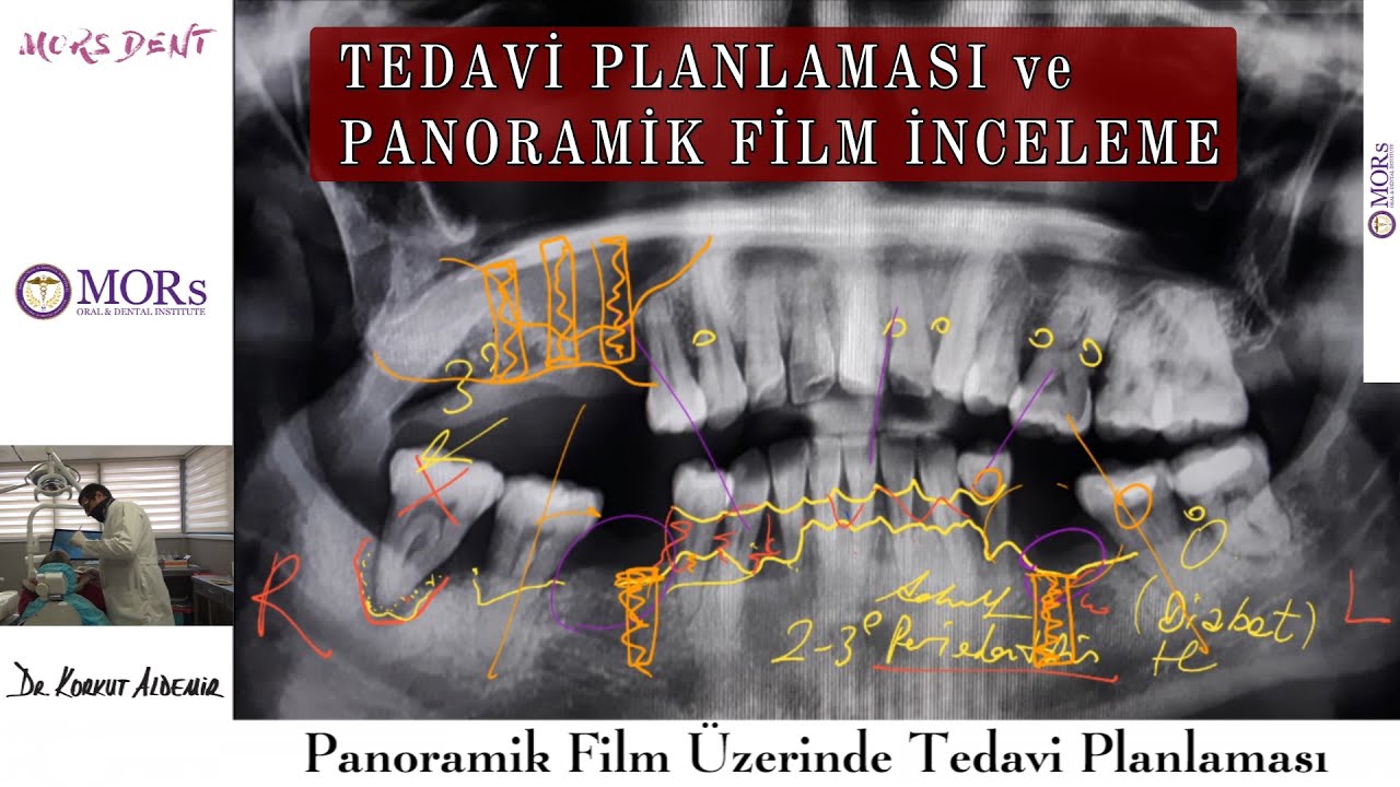 panoramik film üzerinde implant diş ve tedavi planlaması