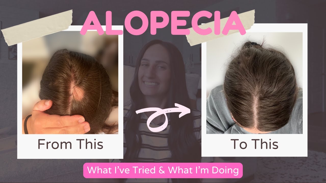 Hair Regrowth From Alopecia Areata | What I've Tried & What I'm Currently Doing to See Results!