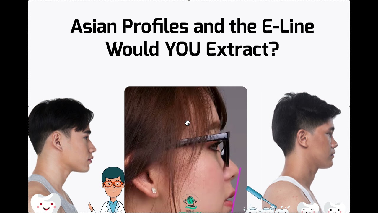 Asian Profiles and the E-Line. Would you Extract?