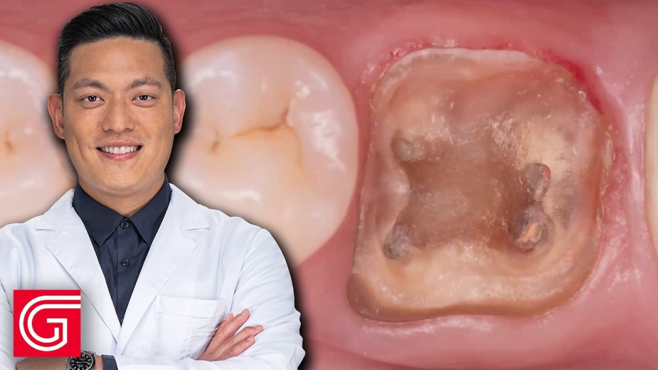 Addressing a Lack of Coronal Tooth Structure with an Endo Crown