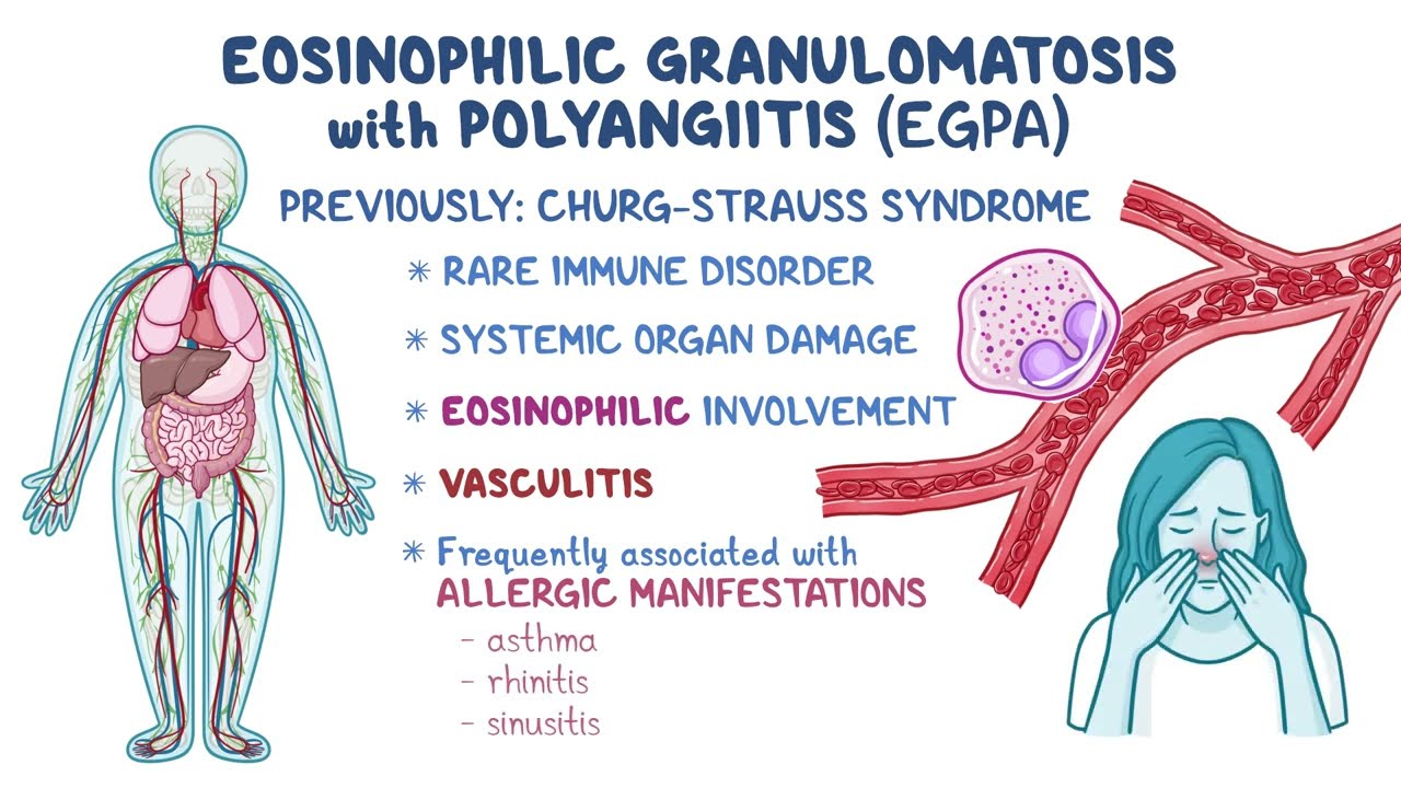 Eosinophilic granulomatosis with polyangiitis (EGPA): Signs, Symptoms & the Path to Remission