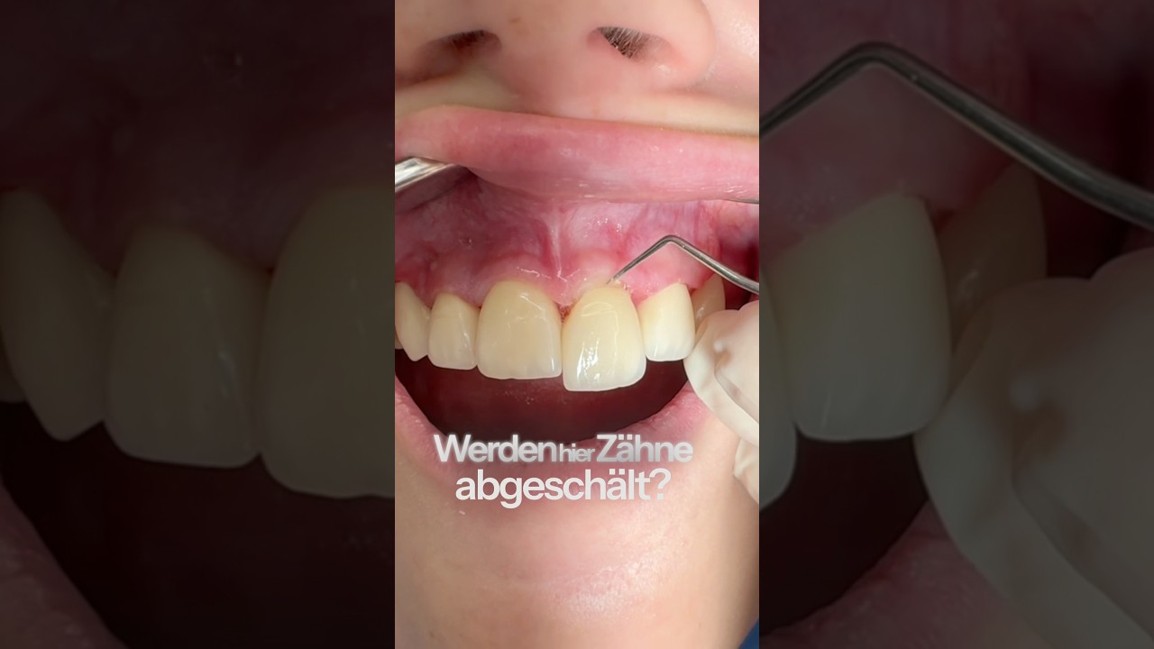 ZAHNKRONEN sichern stark zerst&ouml;rte Z&auml;hne und sollten v&ouml;llig nat&uuml;rlich aussehen! #zahnkrone