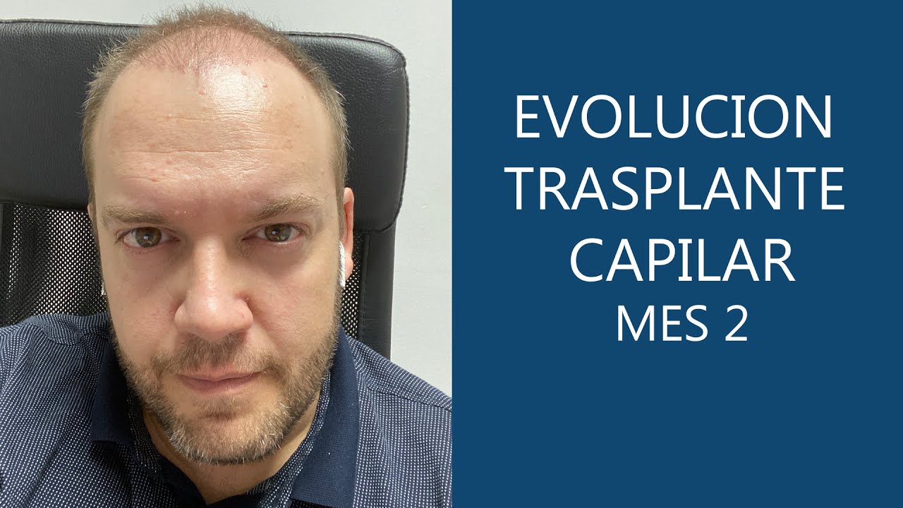 Evolución Trasplante capilar en Turquía - 2 meses