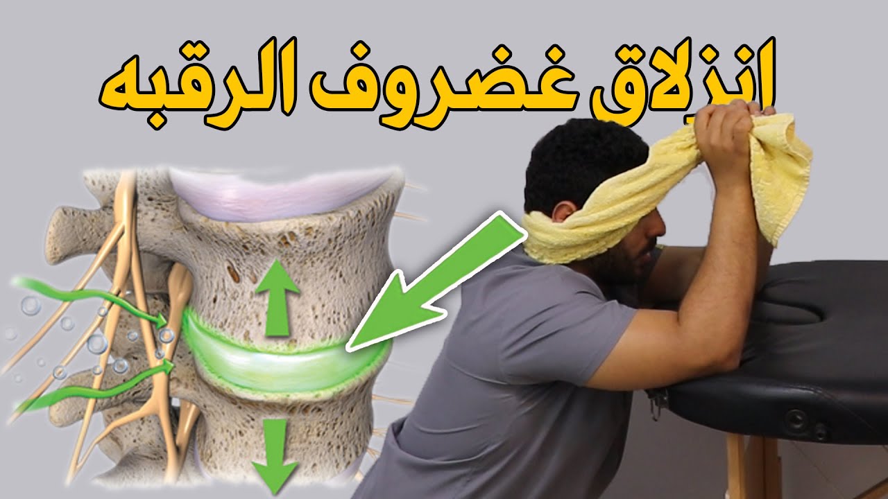 علاج انزلاق غضروف الرقبه بخطوه واحده فقط/شد فقرات الرقبه بنفسك فى البيت