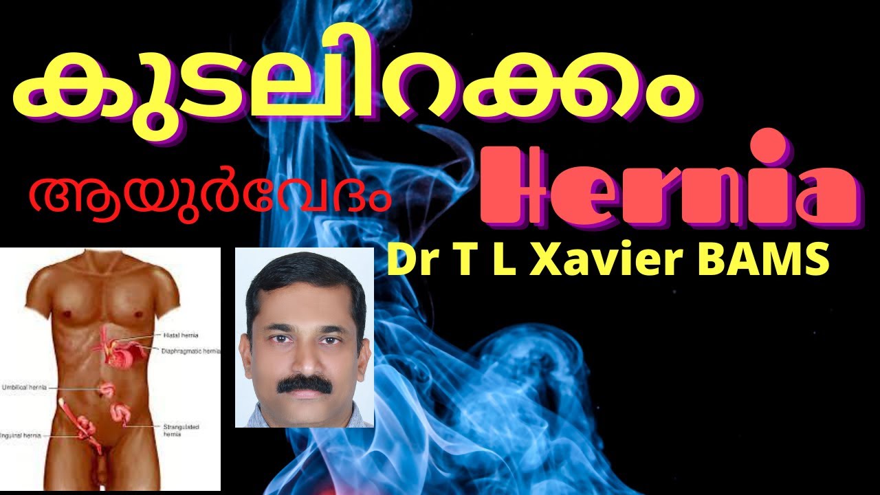 കുടലിറക്കം | Hernia Ayurvedic Treatments Diet Lifestyle Precautions | Ayurvedic View  Dr T L Xavier