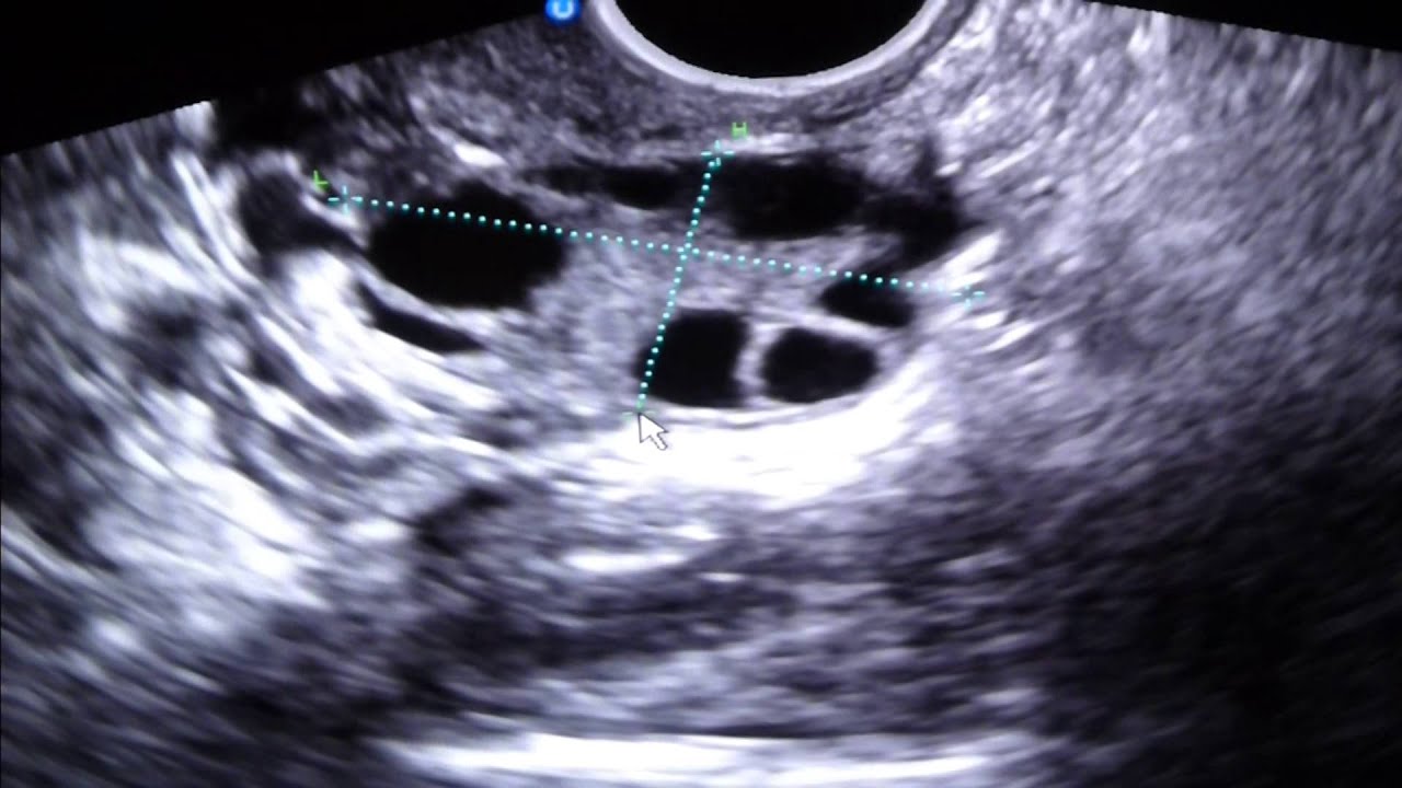 Day 6 Ultrasound of In Vitro Cycle - Checking for Follicle Growth