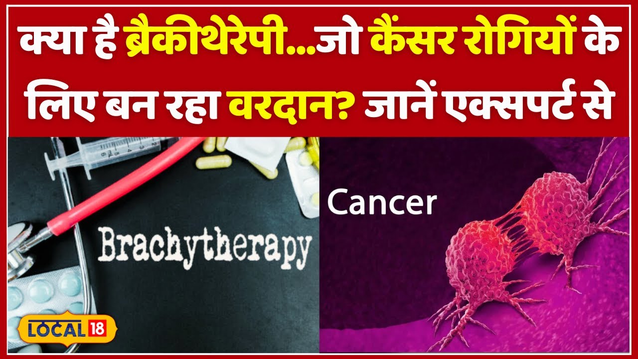 Brachytherapy: Cancer Treatment हुआ आसान और असरदार! जानिए इसके फायदे और खर्च! | Cancer News #local18