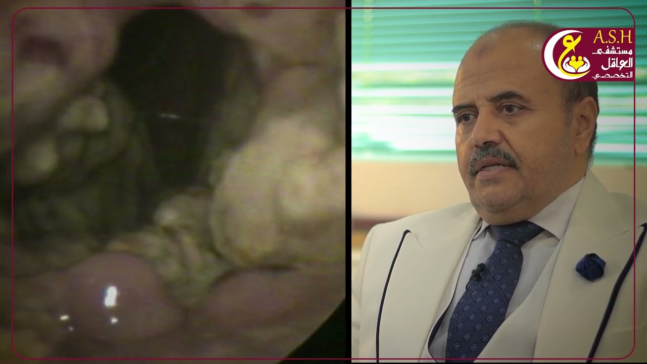 تليف أعلى الحنجرة أو تليف لسان المزمار