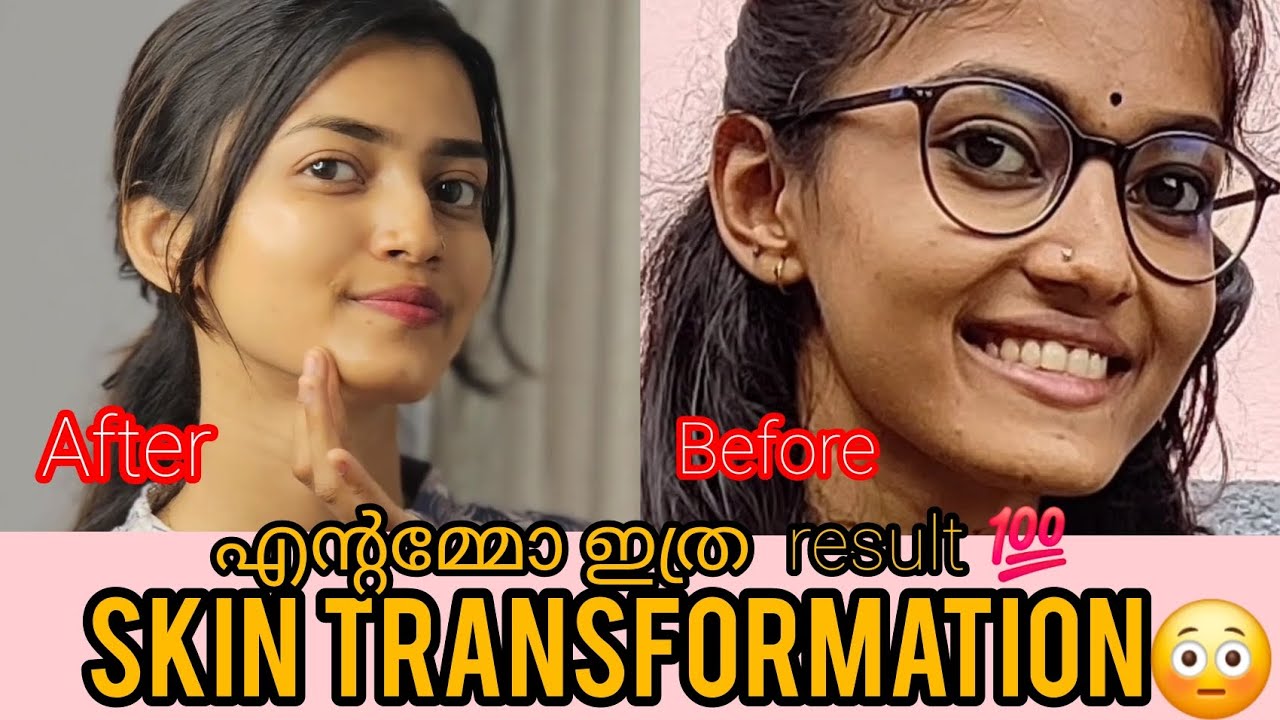 skin transformation😳 എന്റമ്മോ എത്ര റിസൾട്ട്💯 #skincaremalayalam #beforeandafter