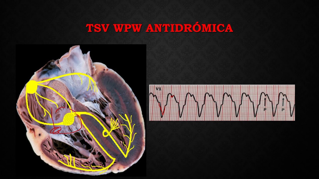 22. ARRITMIAS CONDUCIDAS POR VIAS ACCESORIAS