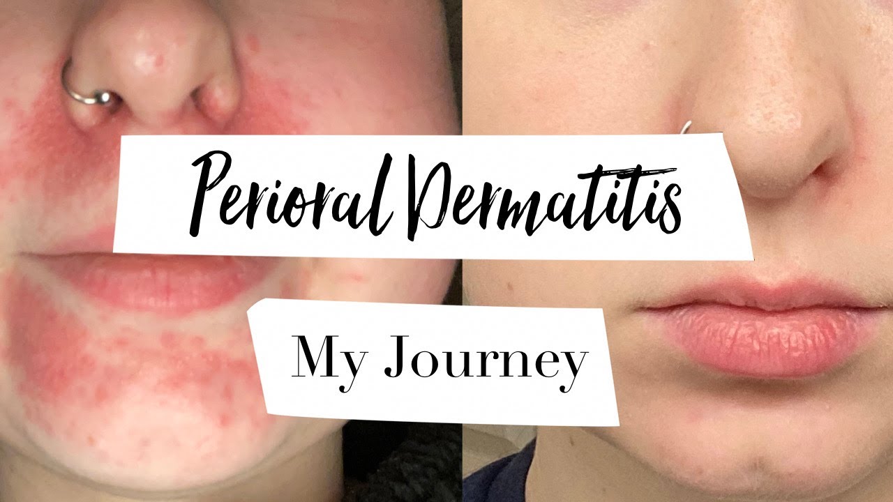 How I Treated My Perioral Dermatitis | MY JOURNEY
