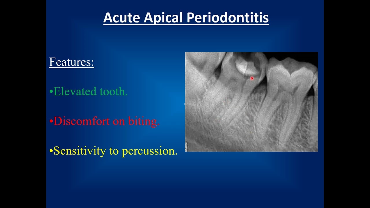 Endodontic emergency treatment