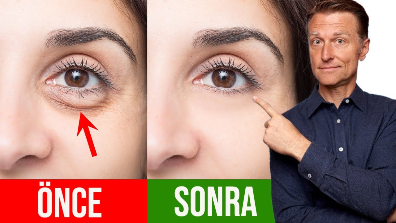 Şiş Gözlerden ve Koyu Halkalardan Nasıl Kurtulur? | Dr.Berg Türkçe