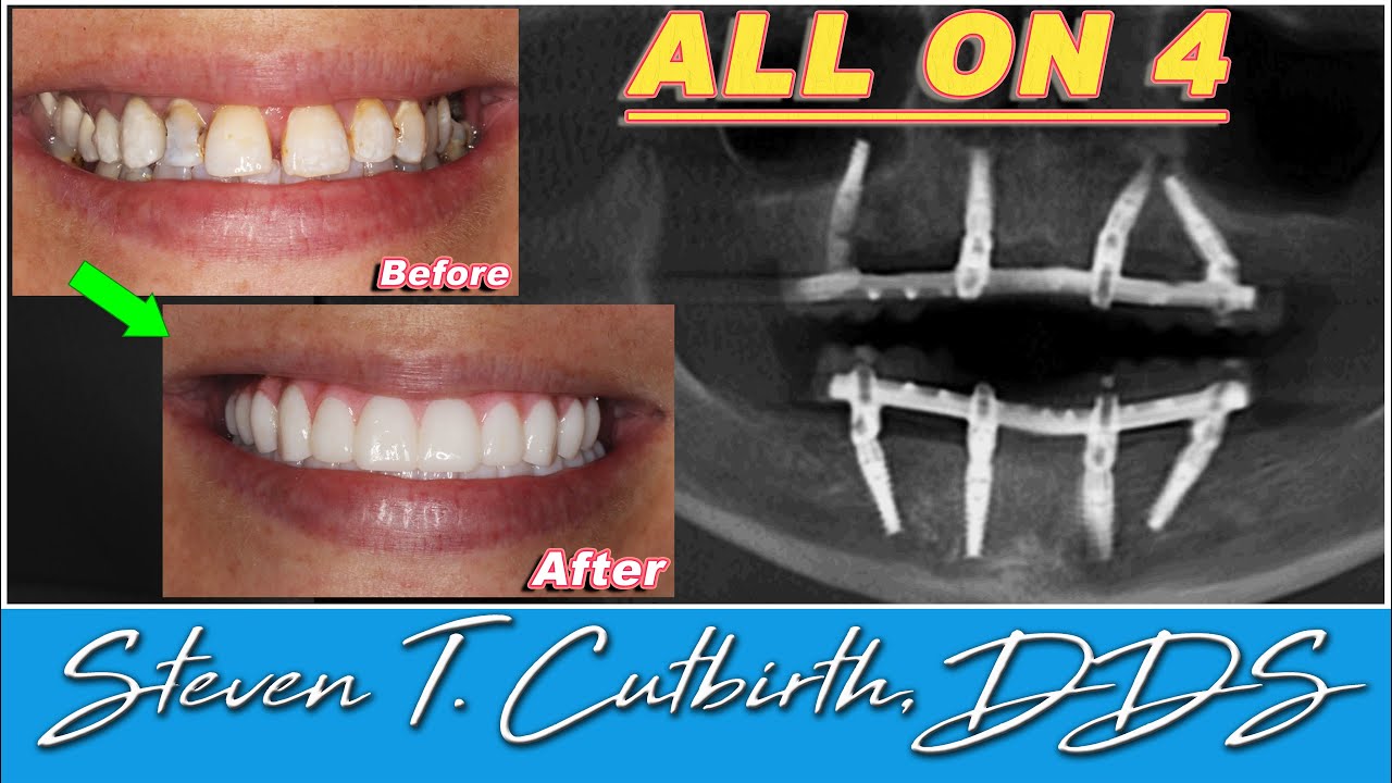 Fabulous All on 4 Dental Cases - Dental Minute with Steven T. Cutbirth, DDS