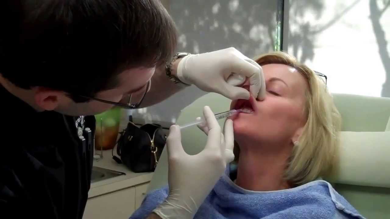 Dr. Seiler Performs Dental Block Pre-Juvederm Smile Lines Treatment