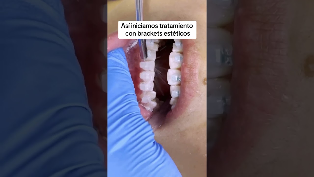 As&iacute; se ven unos brackets est&eacute;ticos 👀
