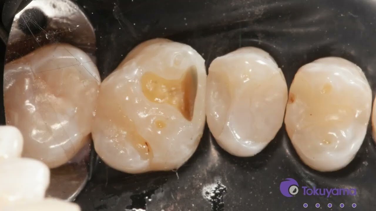 OMNICHROMA Procedure video with Dr KB