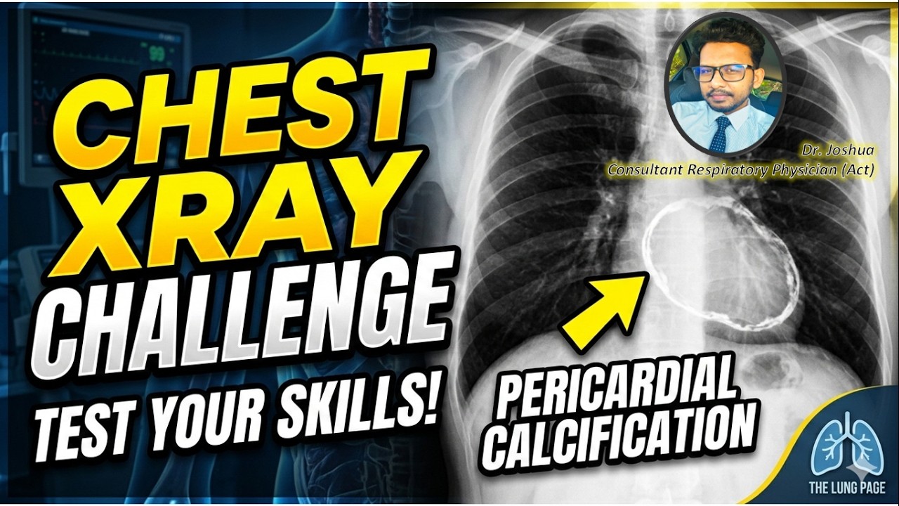 Chest X-ray Challenge - 9 - Pericardial Calcification