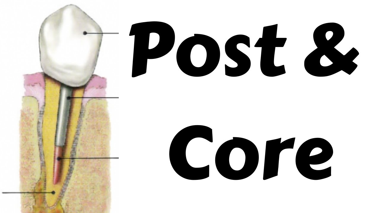 Post & Core post preparation procedure in endodontic & prosthodontics- Step by step Dentsply calibra