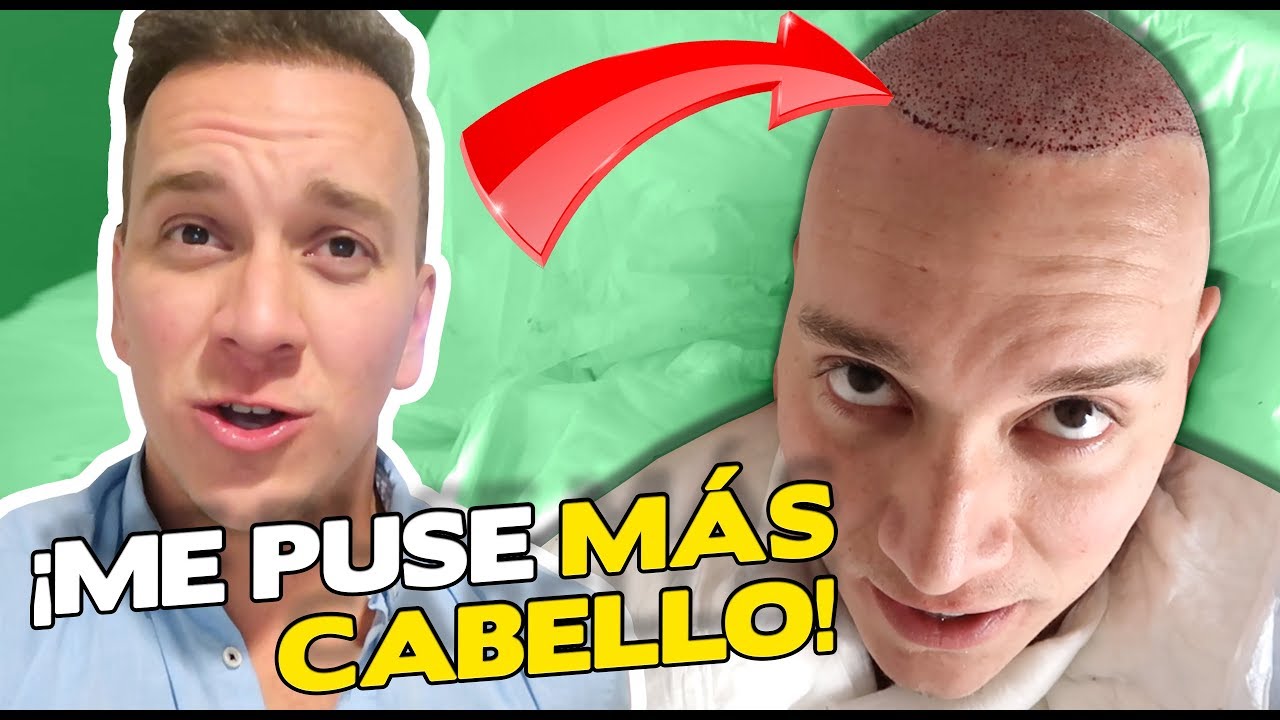 ¡ME HICE UN 2do TRASPLANTE DE CABELLO! 😱 - Oscar Alejandro