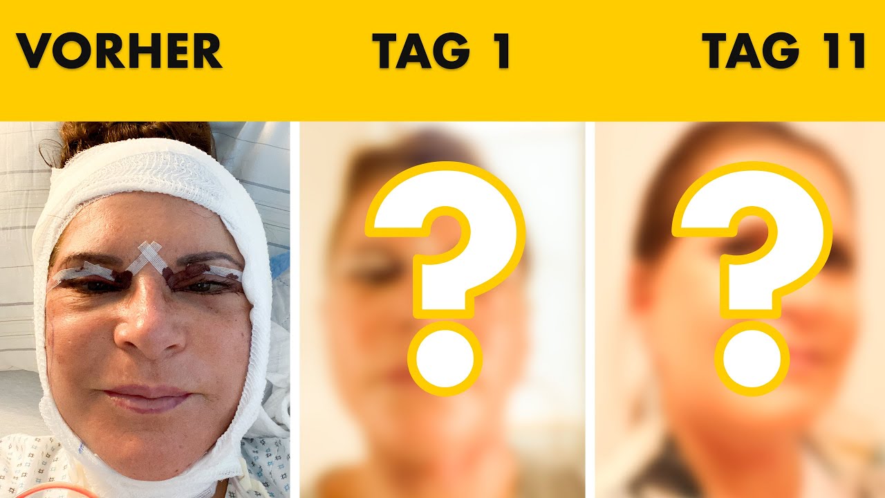Sie zeigt ihr Facelift Tagebuch! Tag 1 bis 11 nach OP