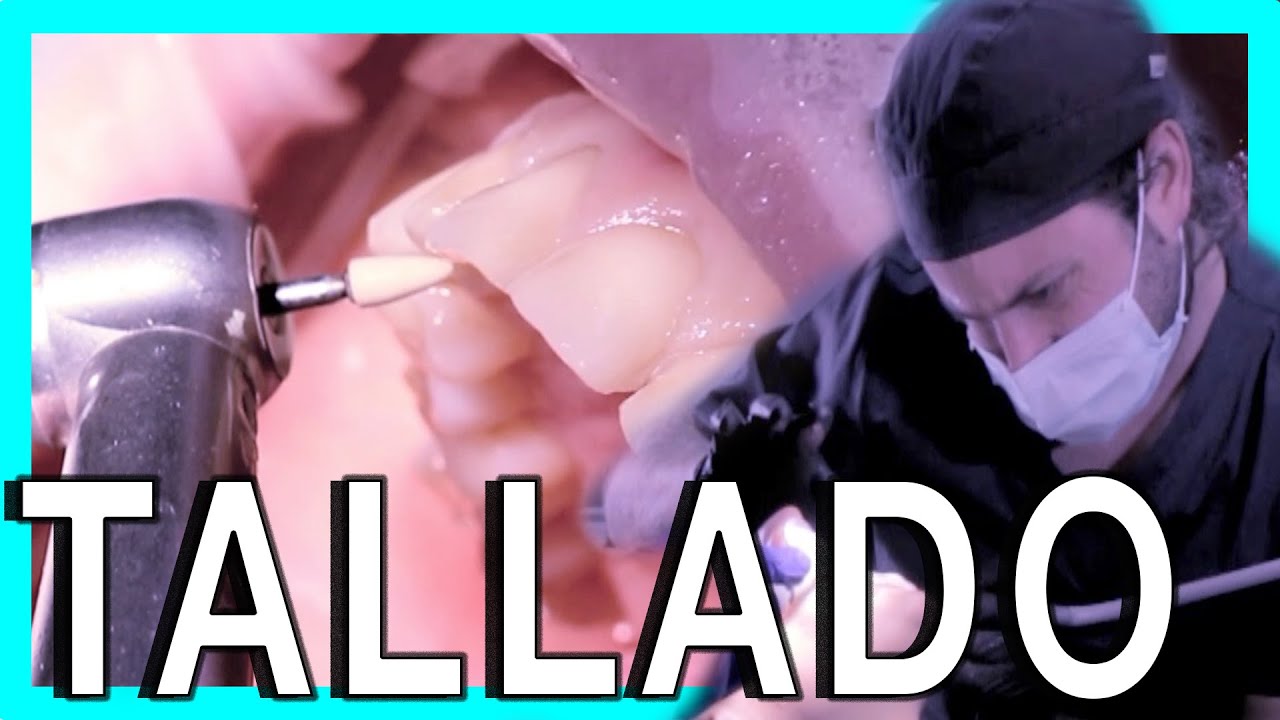 👉TALLADO CARILLAS FELDESPATICAS . Como se realiza el tallado paso a paso para colocar carillas.