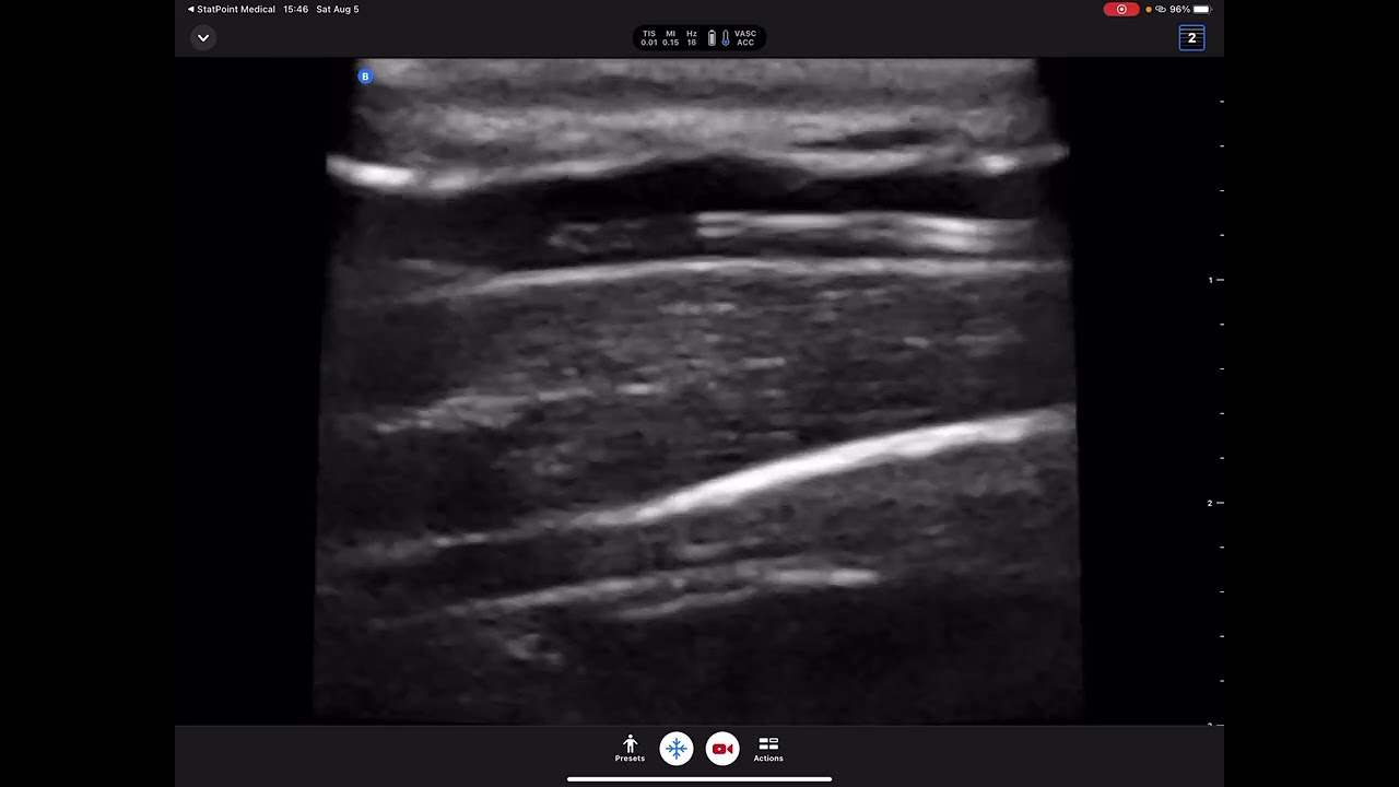 Can't get blood return? Watch this intraluminal thrombus act like a valve! A fibrin t...