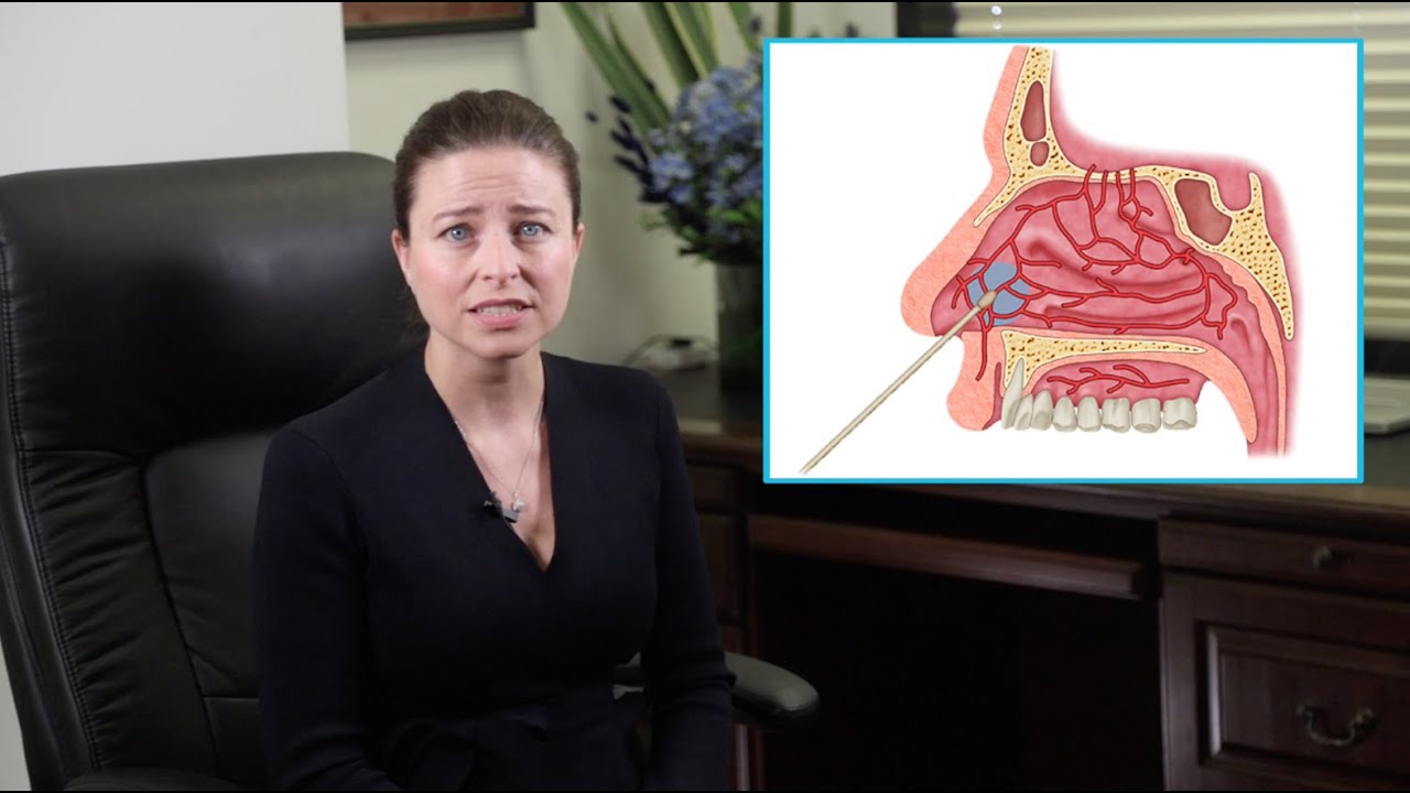 Nasal Cautery - A procedure to stop nose bleeding