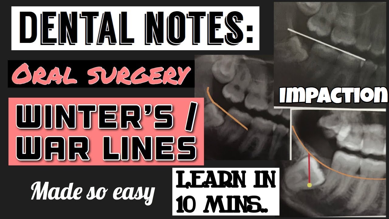 WINTER&rsquo;S or WAR LINES || IMPACTION || ORAL SURGERY || DENTAL NOTES || STUDY WITH ME (made so easy)