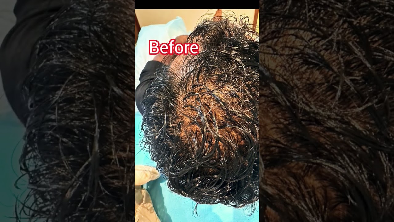 Bald to Bold 