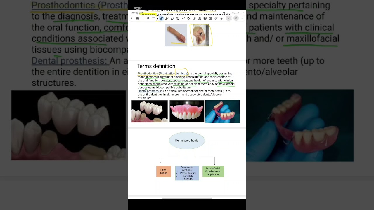 Prosthodontics  lec1 مرحله ثانيه طب الاسنان