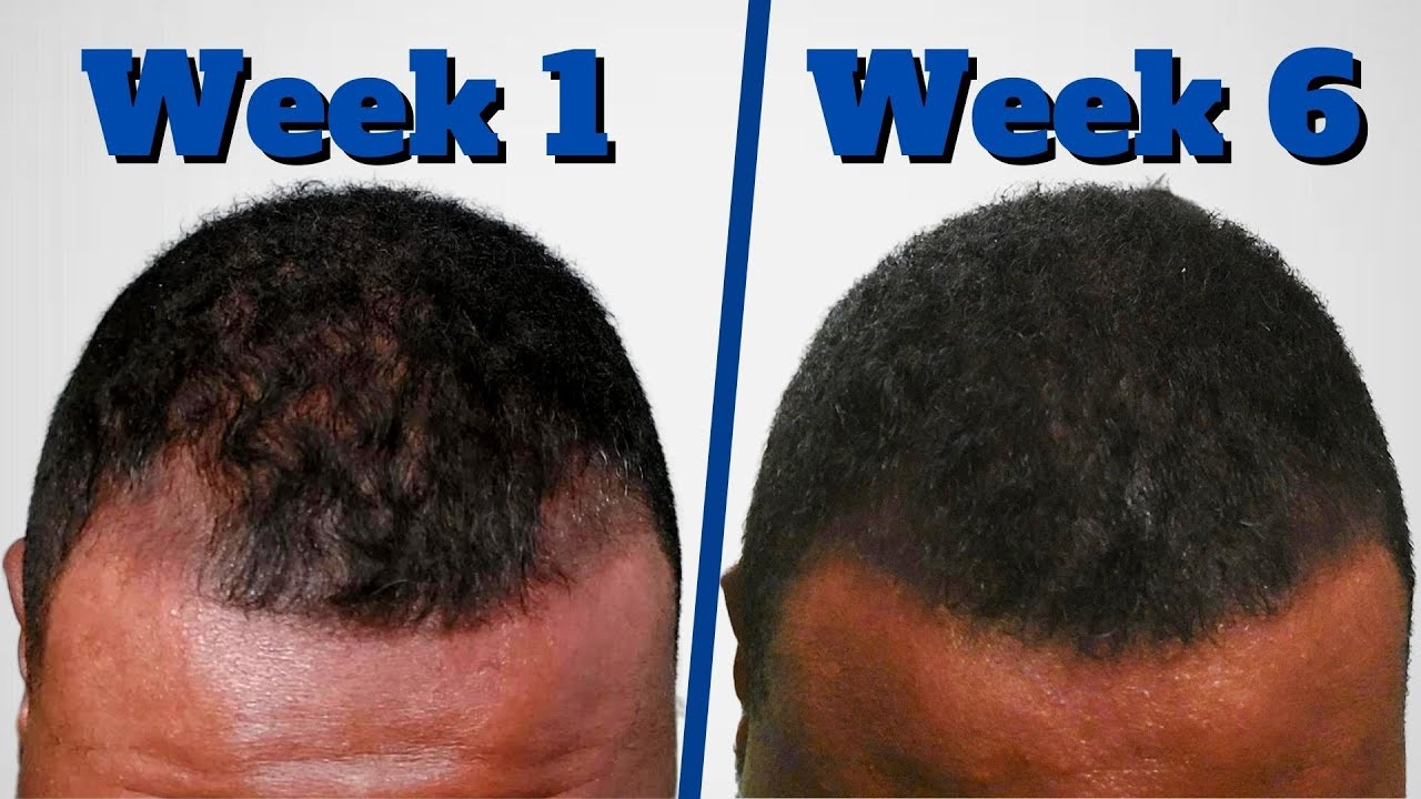 Pyrilutamide: The Latest Hair Loss Treatment REVEALED!