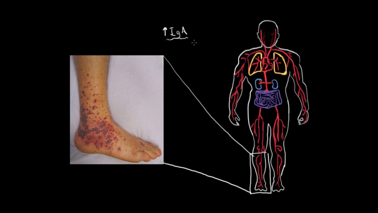 Henoch-Schöolein Purpurası (Fen Bilimleri) (Sağlık ve Tıp)