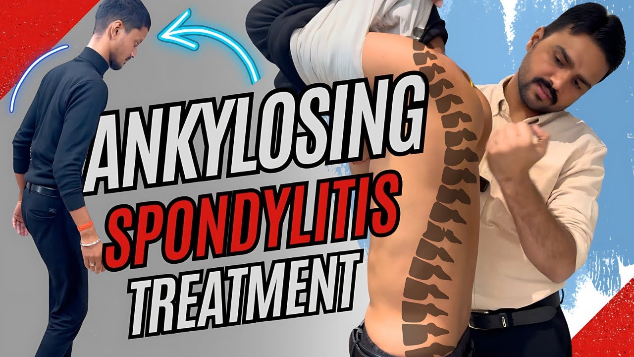 How Chiropractor Help Manage Ankylosing Spondylitis | Dr. Harish Grover
