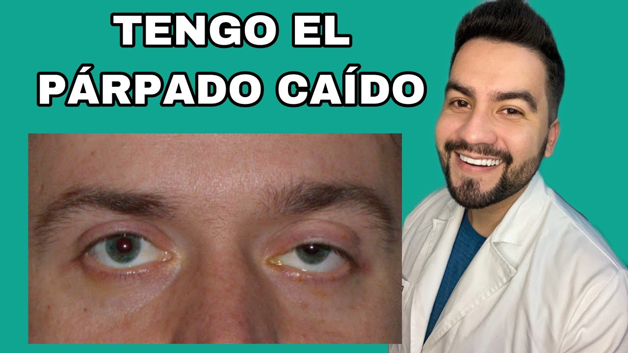 TENGO EL PARPADO CAIDO / PTOSIS PALPEBRAL | DR. DAVID CAMPOS