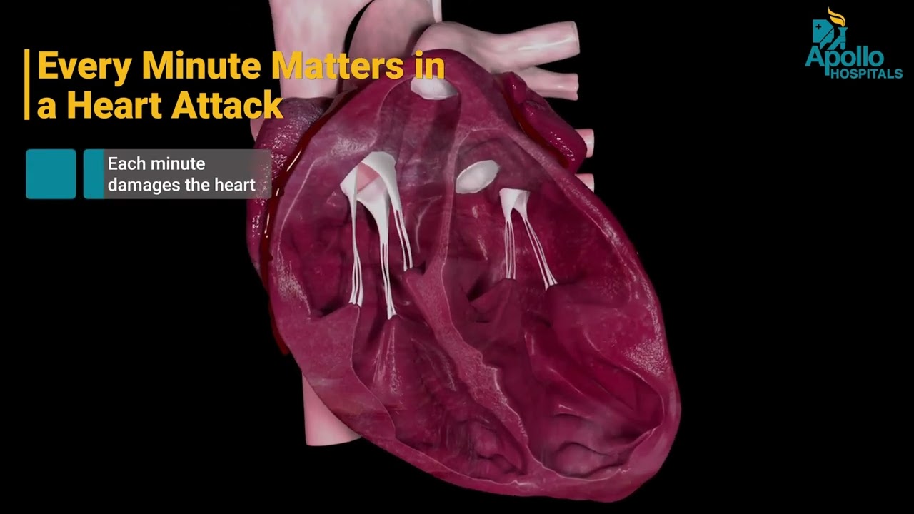 Angioplasty Explained | Symptoms, Procedure & Benefits