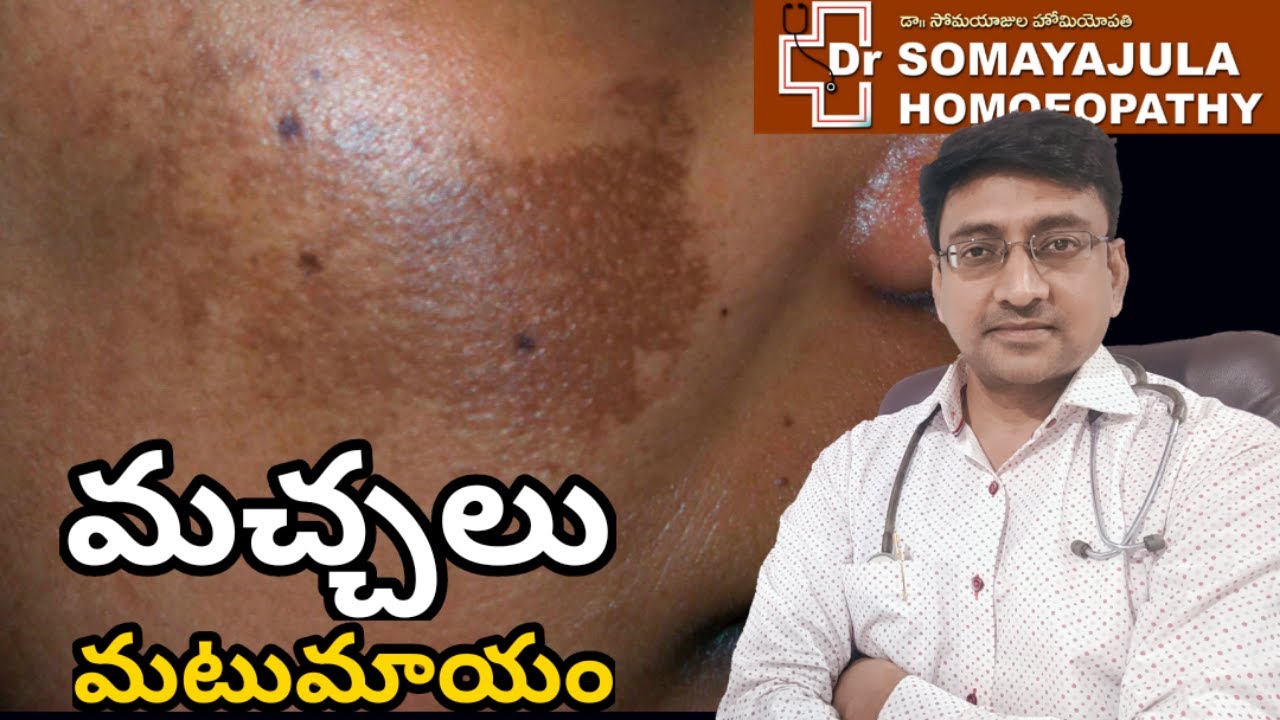 Cure Melasma / Liver spots / DrSomayajula Homeopathy / HealthGuru/Telugu