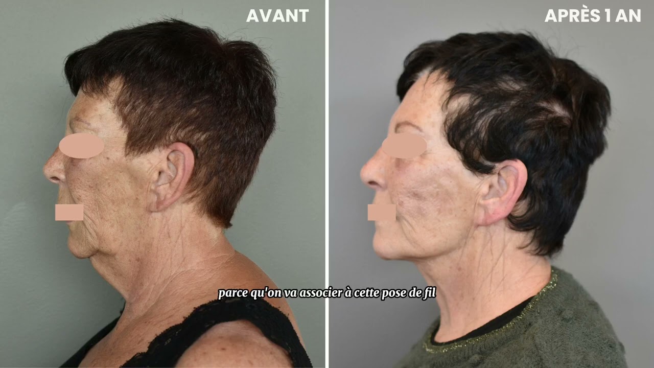 Les Fils Tenseurs Permanents à la Clinique Clemenceau - Docteur Marion Delbaere