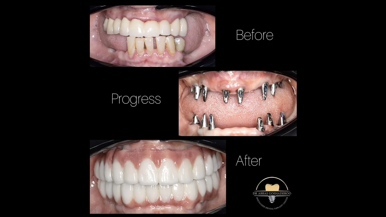 Full mouth rehabilitation with implants