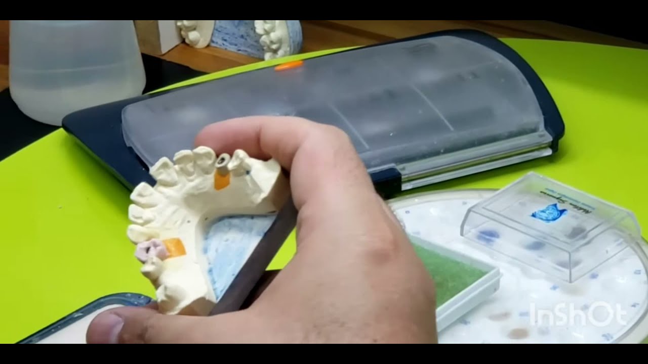 Cerâmicas odontológicas: Da estratificação a injeção
