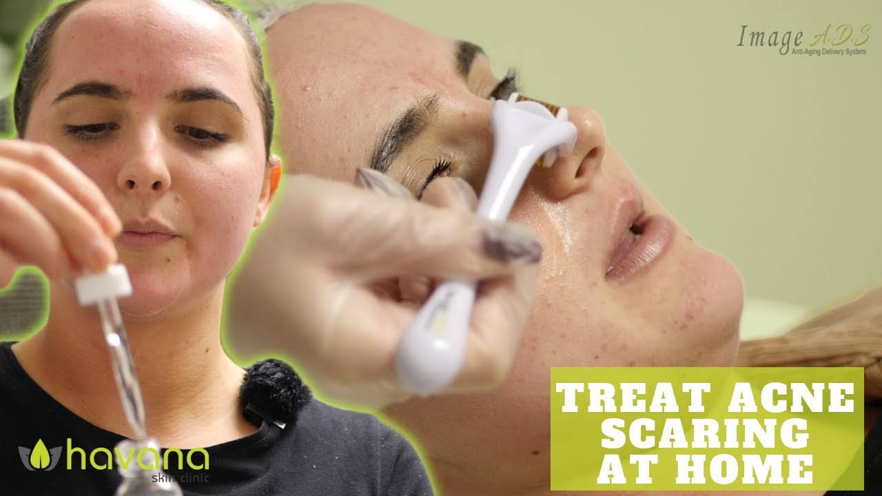 Dermarolling At Home Tips - Treating Dry Sensitive Skin