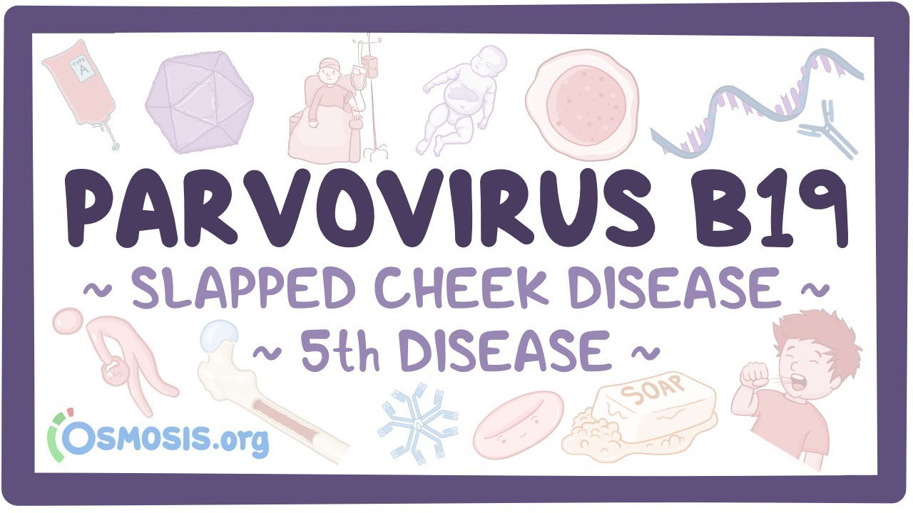 Parvovirus B19 - an Osmosis Preview