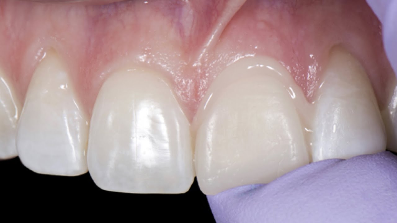 Cementation step by step procedure in fixed prosthodontics