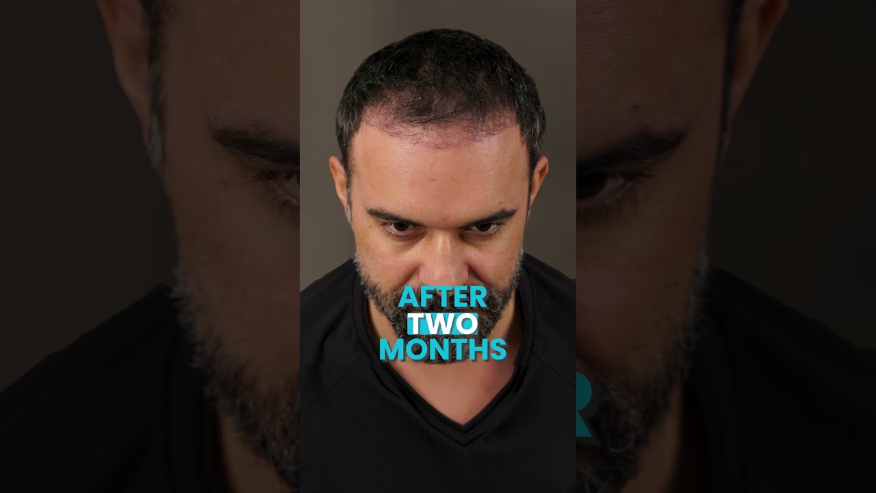 Hair Transplant Time Lapse at Vera Clinic #shorts #hairtransplant #hairtransplantturkey