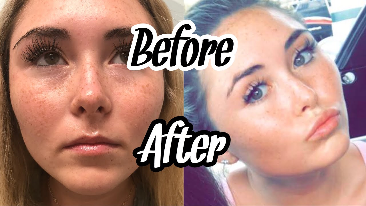 My Lip Injection Experience at 18 (Live Updates and Before & After Pics)