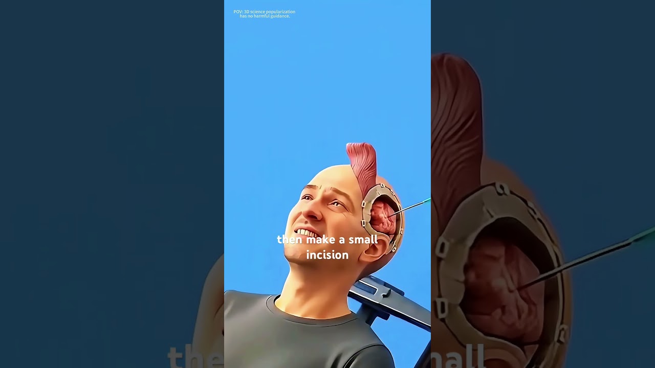 How Craniotomy Surgery Is Performed (3D animation) 