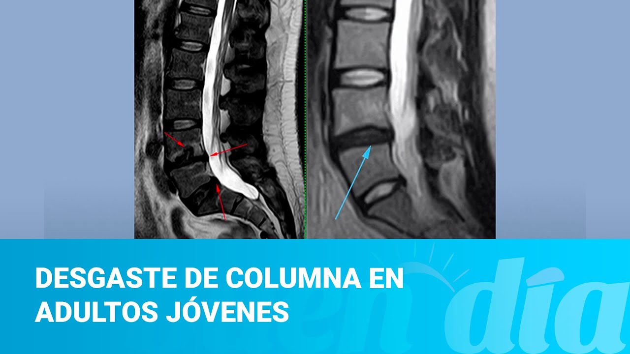 Hablamos de desgaste de columna en adultos jóvenes
