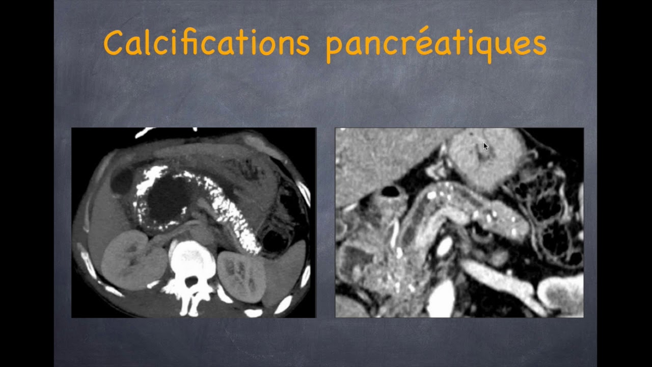 Pancréatite chronique - 1. Diagnostic positif